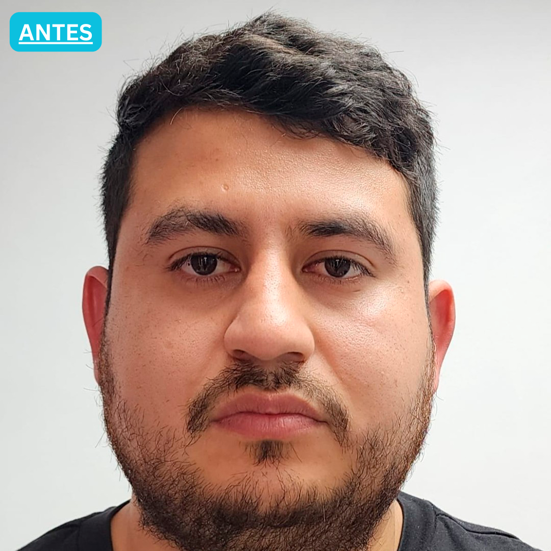 Antes